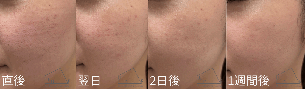 blessingのダウンタイム症例について紹介。症例2