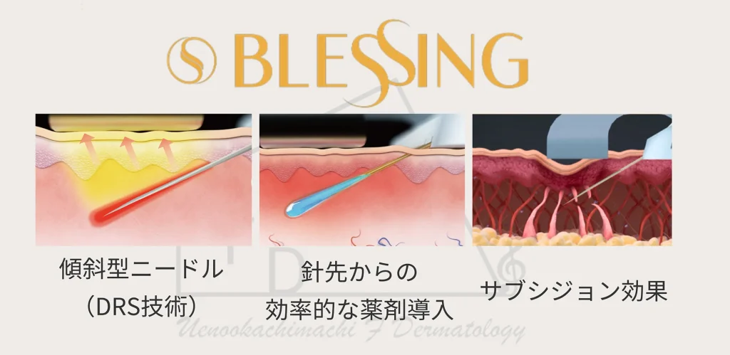 ブレッシングの仕組みについて写真付きで解説します 傾斜型ニードルを使用し 針先から効率的な薬剤を導入　サブシジョン効果も得られます