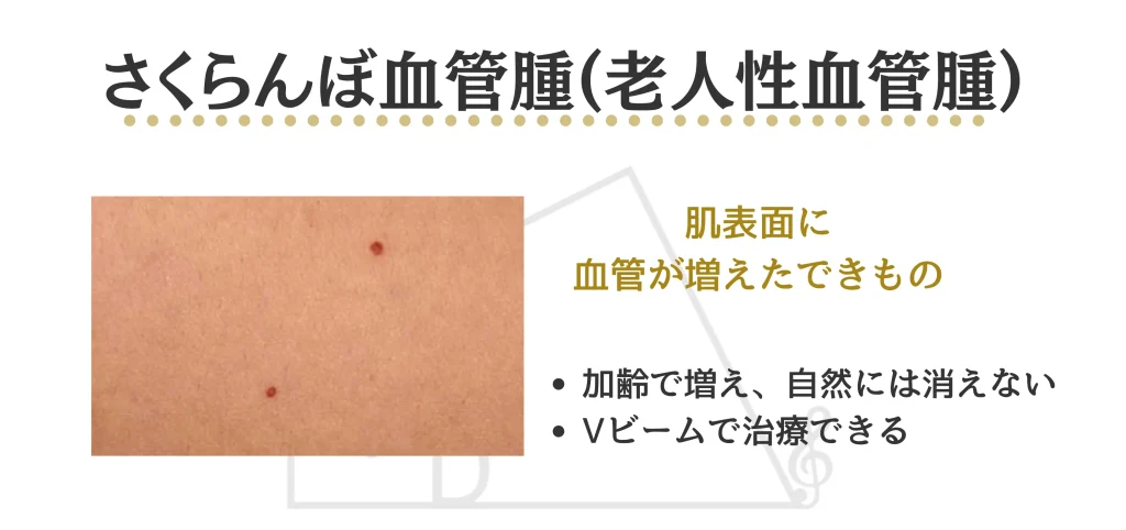 さくらんぼ血管腫とは