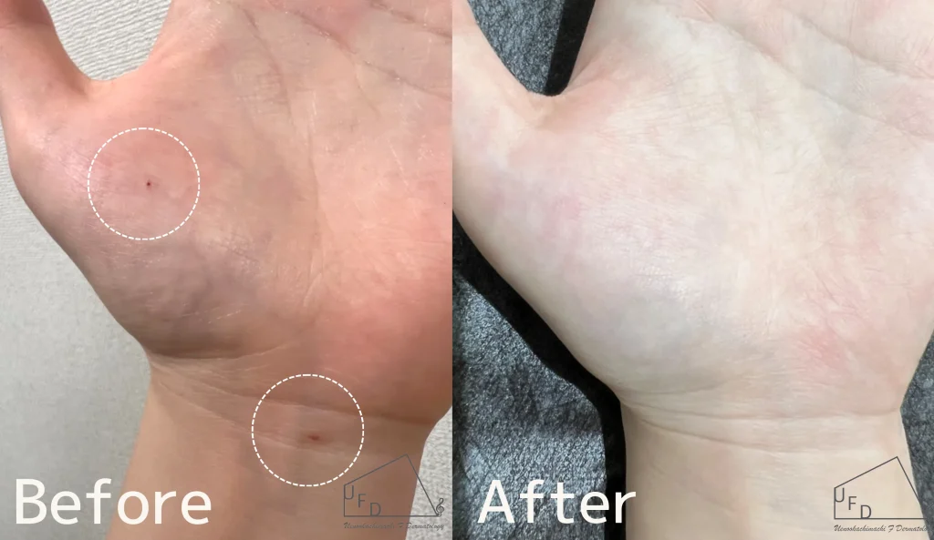 症例1 【30歳代女性】手と手首のさくらんぼ血管腫