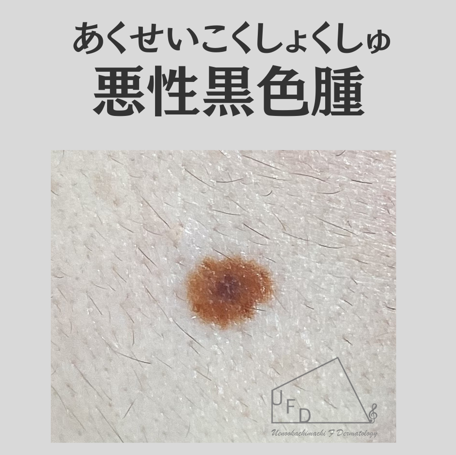 悪性黒色腫(あくせいこくしょくしゅ、メラノーマ melanoma)画像