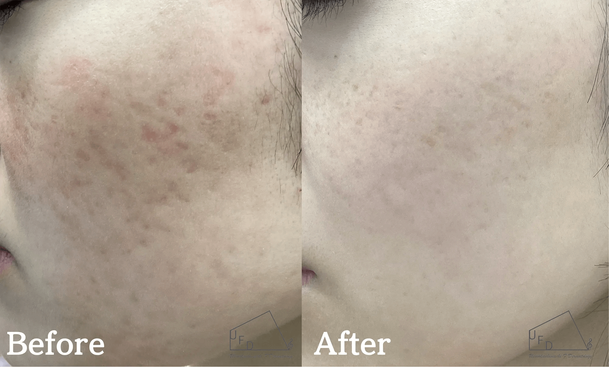 サブシジョン症例3