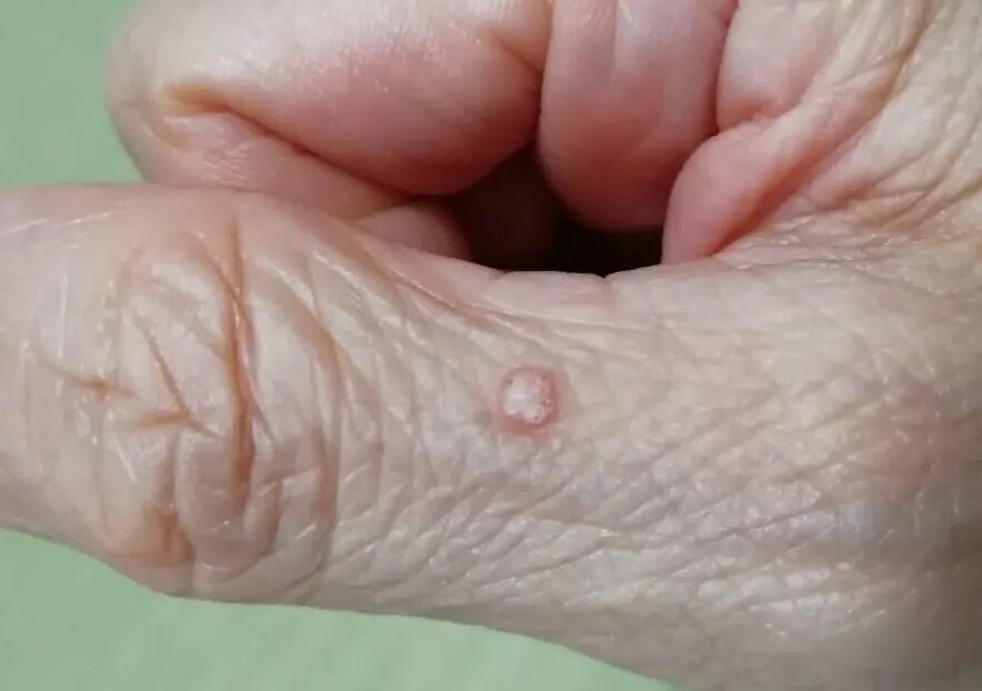 ウイルス性イボ （尋常性疣贅） - 上野御徒町ファラド皮膚科