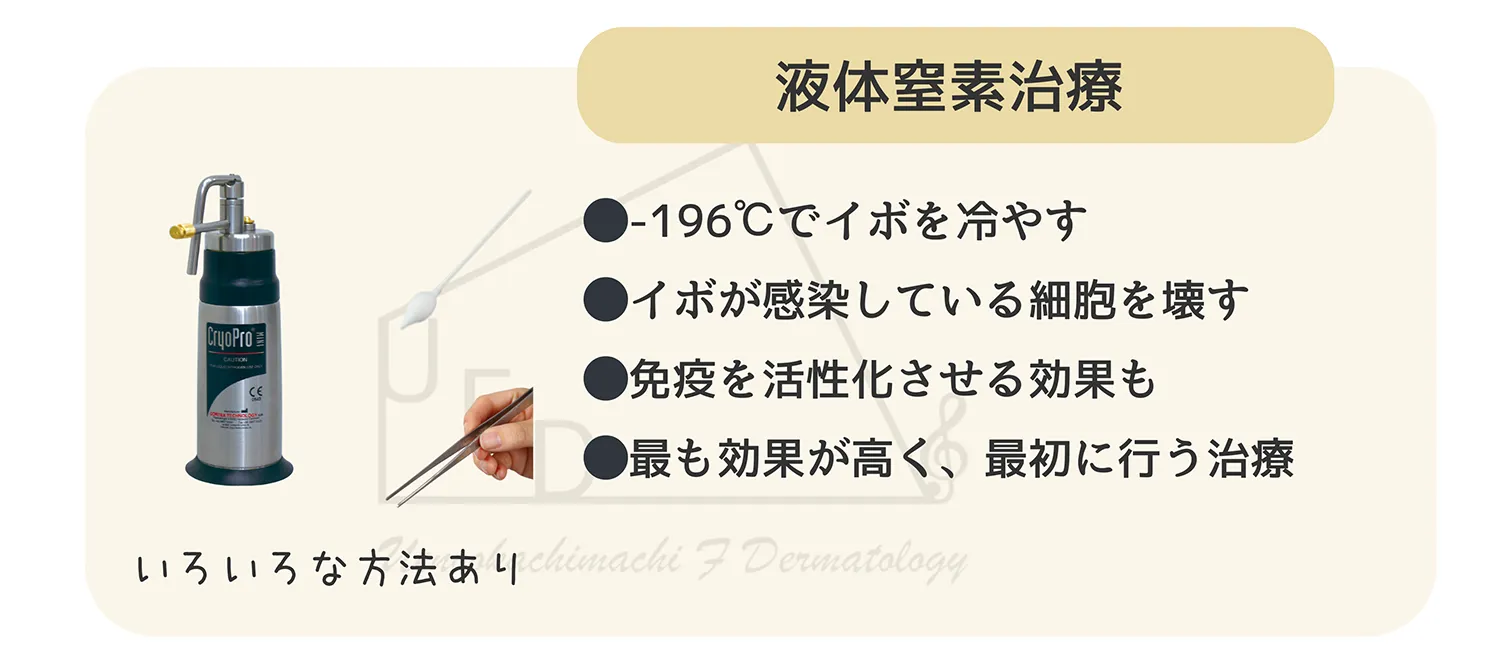 冷凍凝固療法