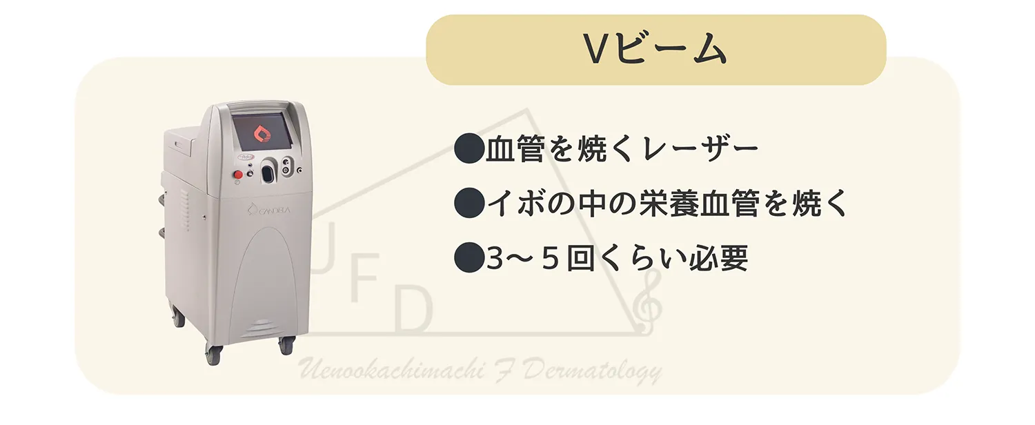 Vビーム