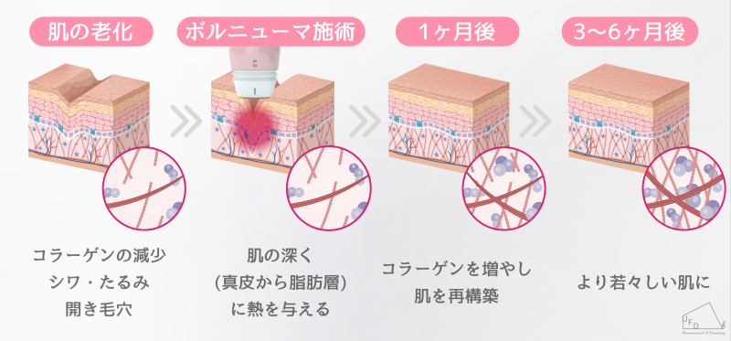 ボルニューマの仕組み画像