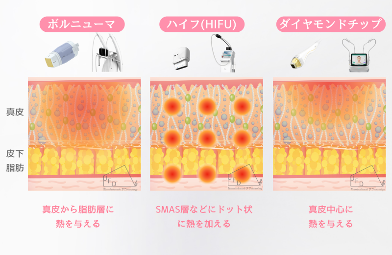 ボルニューマとハイフ(HIFU)やポテンツァダイヤモンドチップとの違い画像